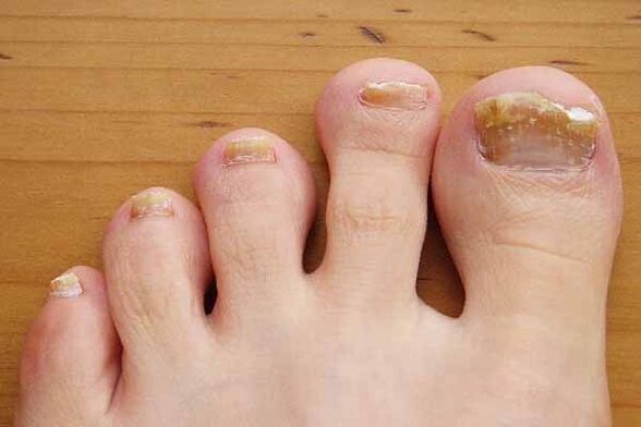 Aspetto delle unghie dei piedi colpite da funghi