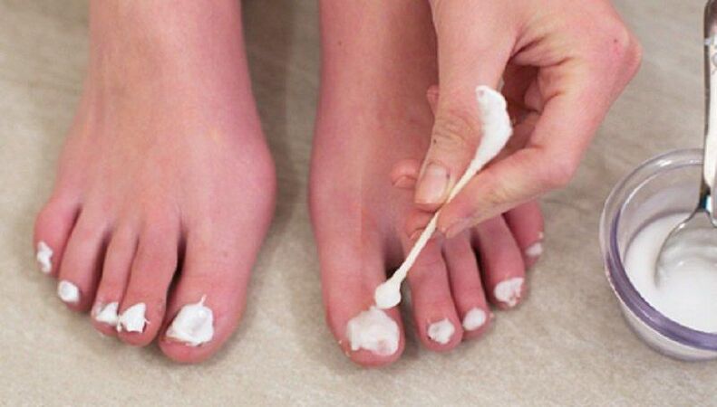 Trattamento tradizionale per i funghi delle unghie dei piedi