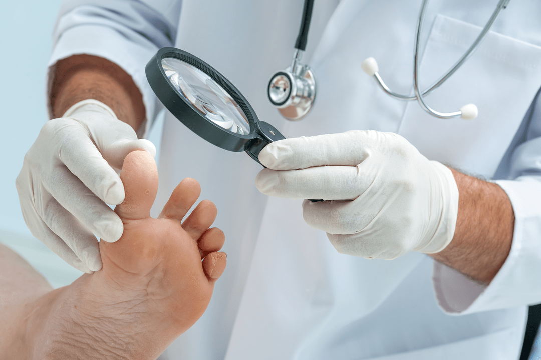 diagnosi del fungo dell'unghia del piede