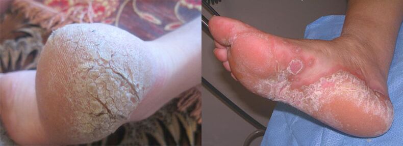 I piedi colpiti dal fungo