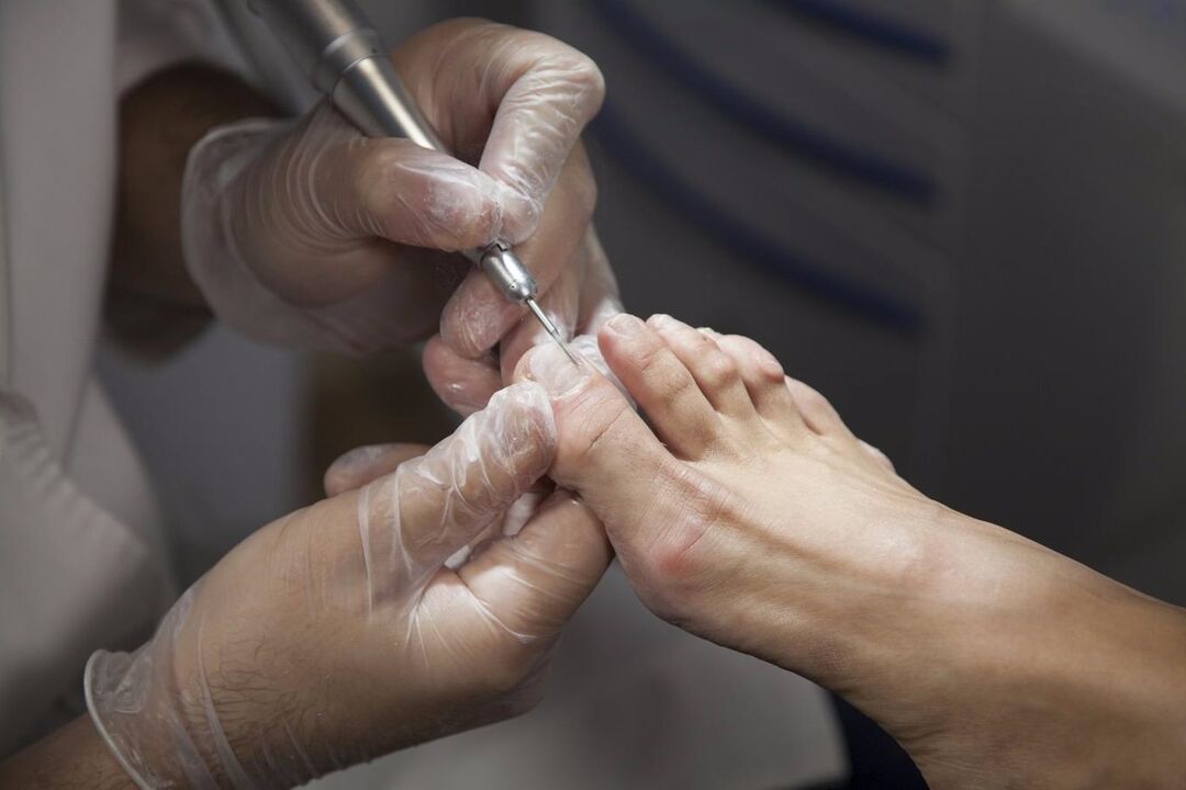 trattamento professionale per il fungo dell'unghia del piede