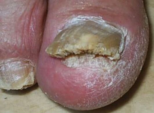 foto del fungo dell'unghia del piede