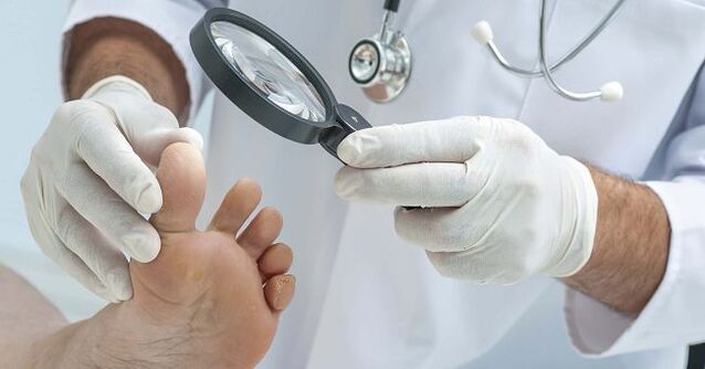 Il medico prescriverà un rimedio per il fungo dell'unghia del piede dopo aver diagnosticato la malattia