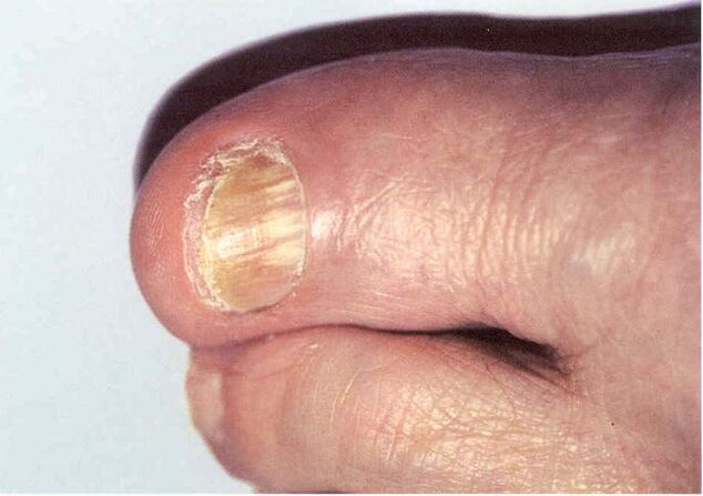 Onicomicosi - infezione delle unghie dei piedi da parte di funghi