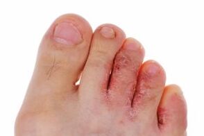 infezione fungina delle dita dei piedi