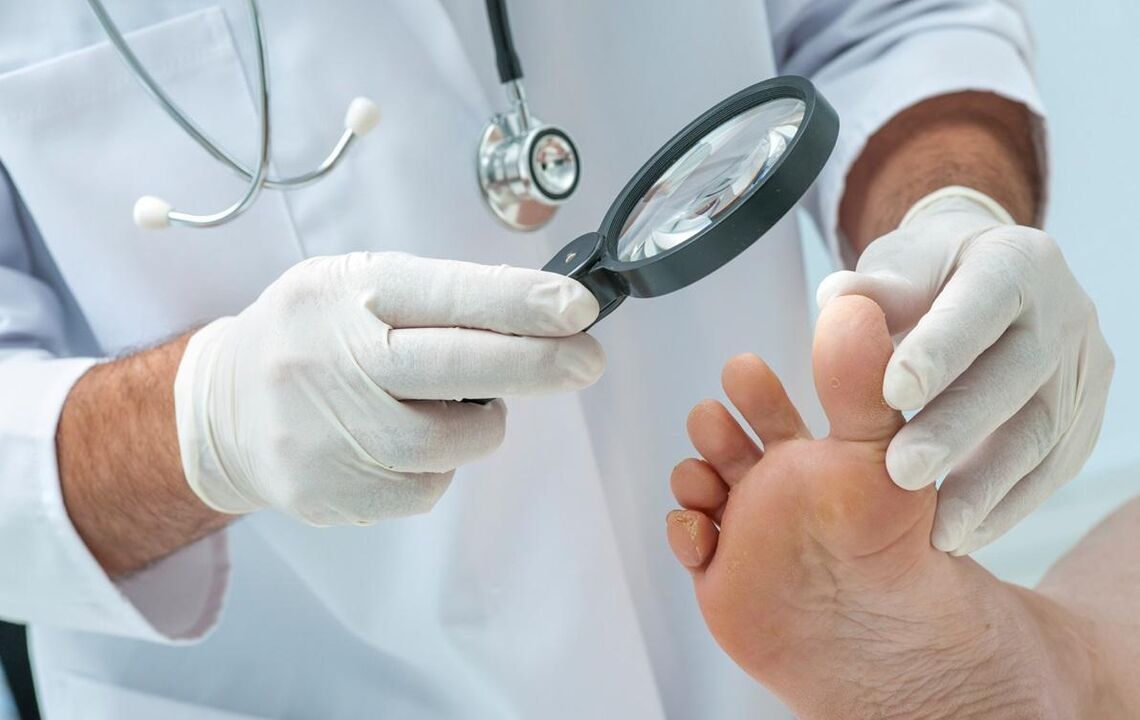 il medico esamina le unghie per i funghi