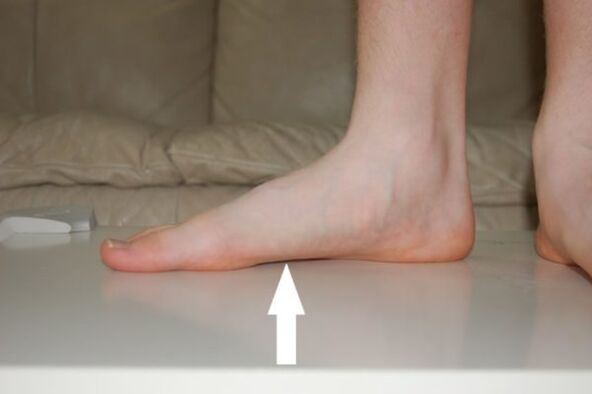 I piedi piatti sono una delle cause dei funghi alle unghie dei piedi