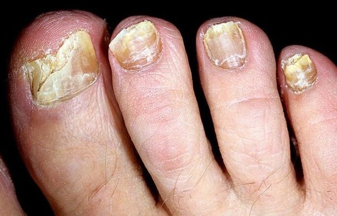 Fungo avanzato dell'unghia del piede che richiede un trattamento complesso